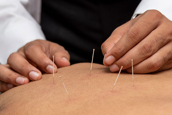 Acupuncture 