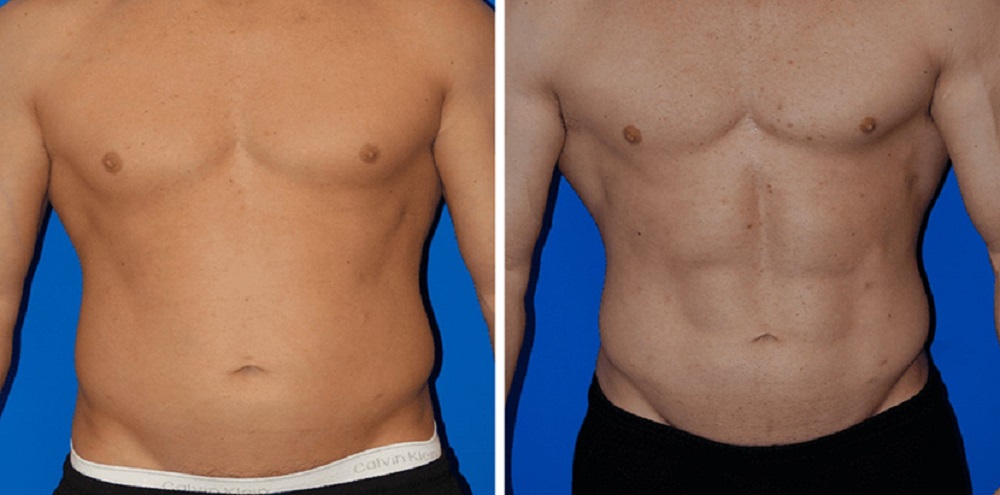 Vaser Liposuction